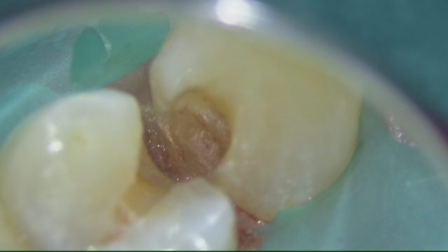 医療法人社団SEEDのマイクロスコープによる虫歯治療